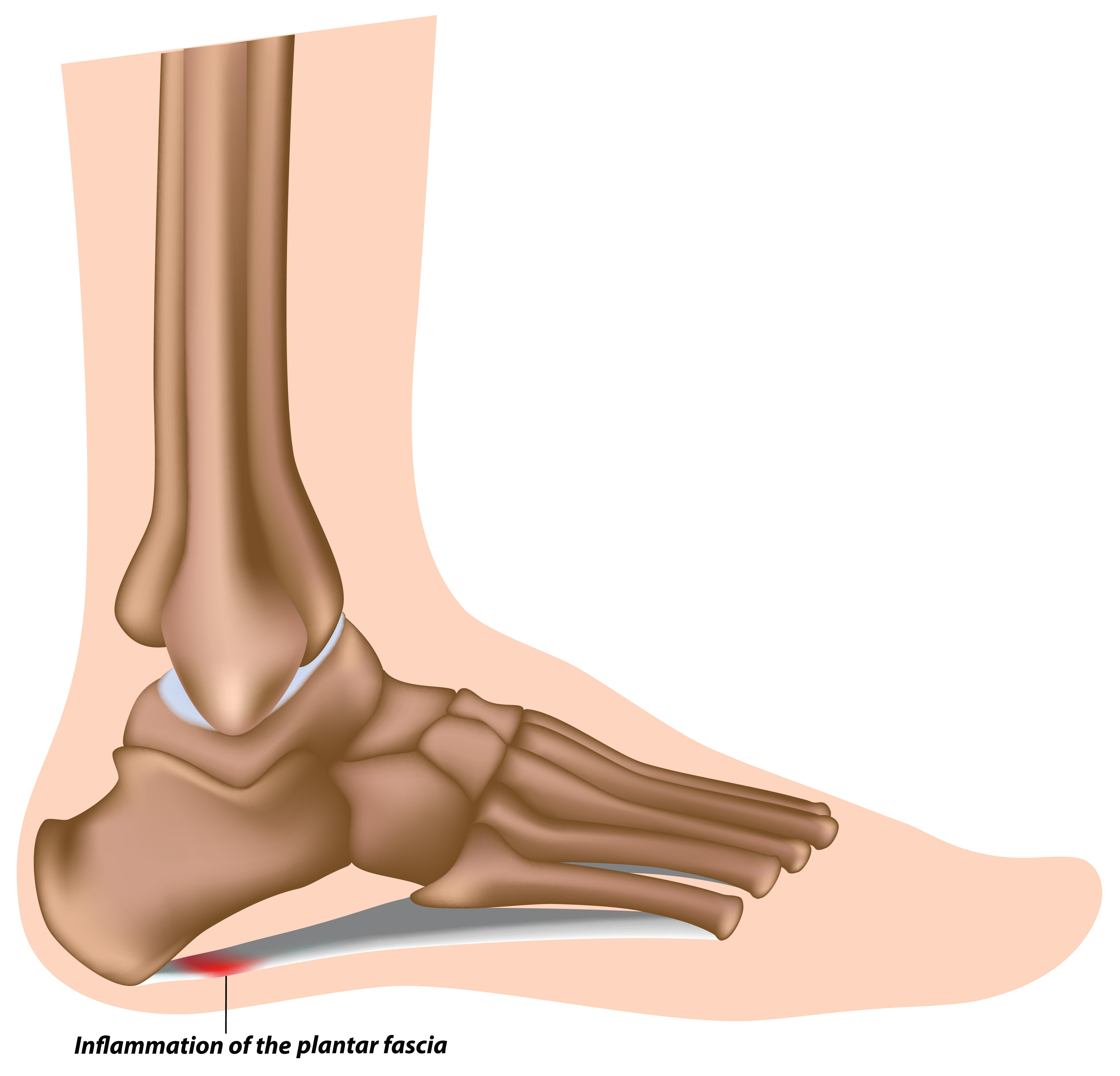 An anatomical diagram illustrates the skeletal structure of a human foot, highlighting a small red inflamed area on the plantar fascia ligament near the heel.