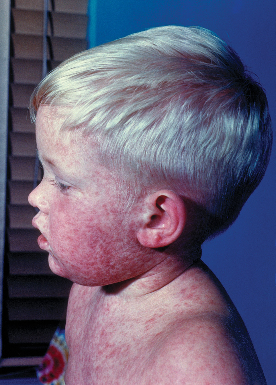1151-measles