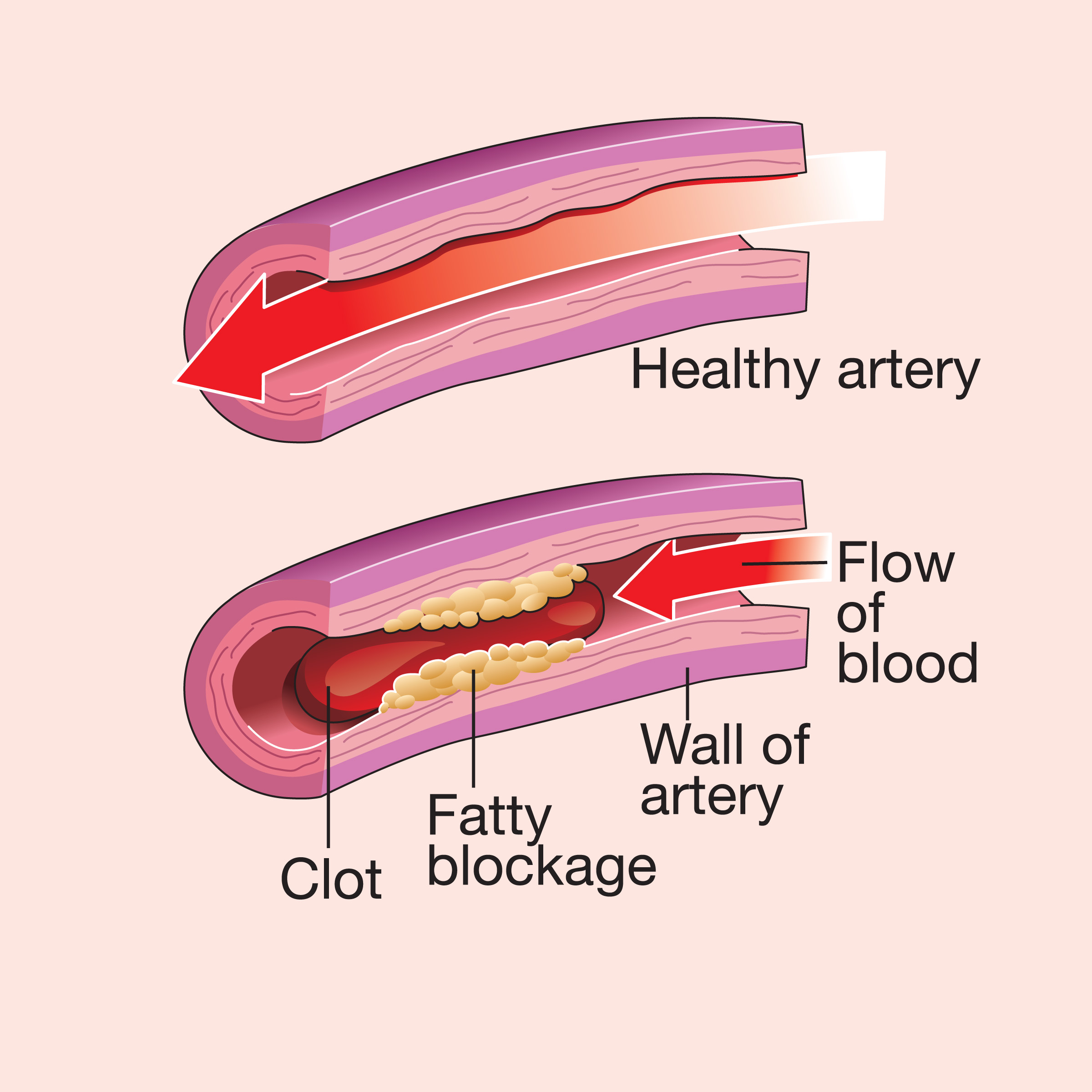 Anatomical diagram contrasting a healthy open artery showing smooth blood flow with an unhealthy artery narrowed by a fatty blockage and obstructed by a blood clot.