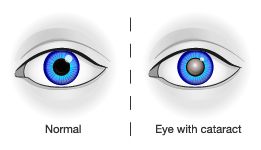 An illustration comparing a healthy eye to one with a cataract distortion.