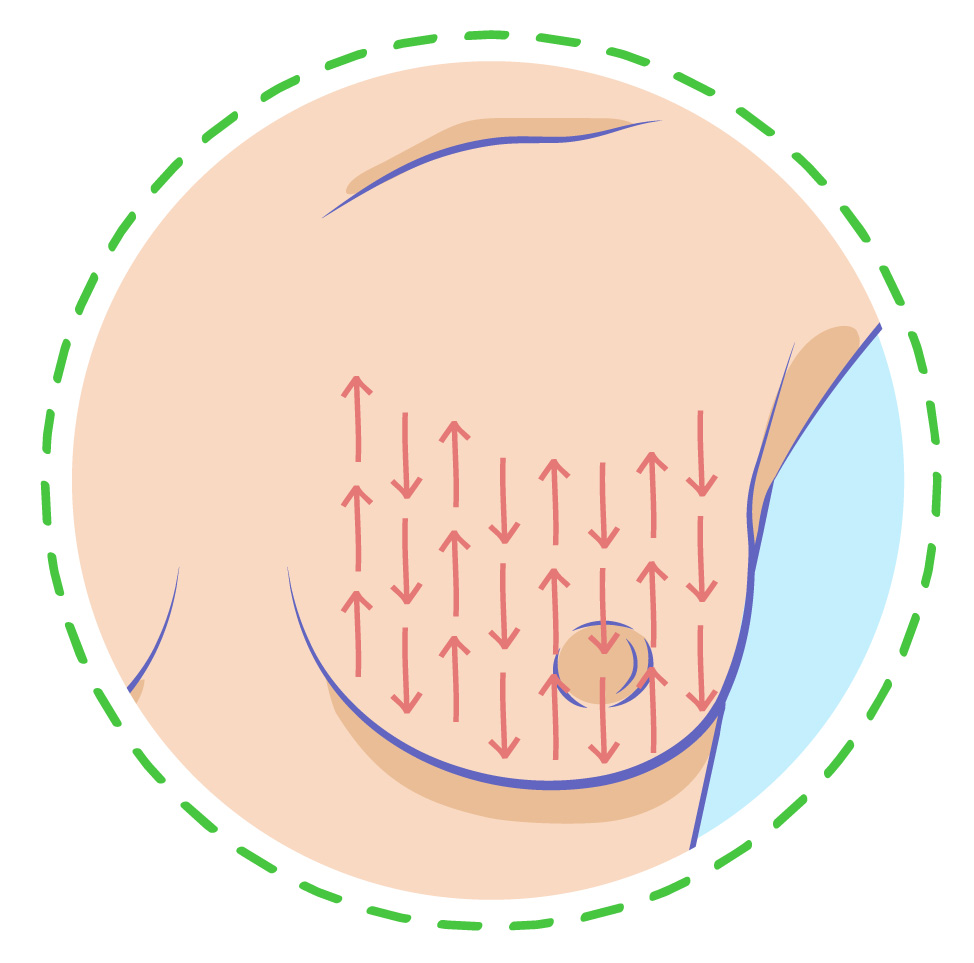 An illustrated diagram within a circle showing a pattern of vertical up-and-down red arrows across a breast to guide the movement during a self-exam.