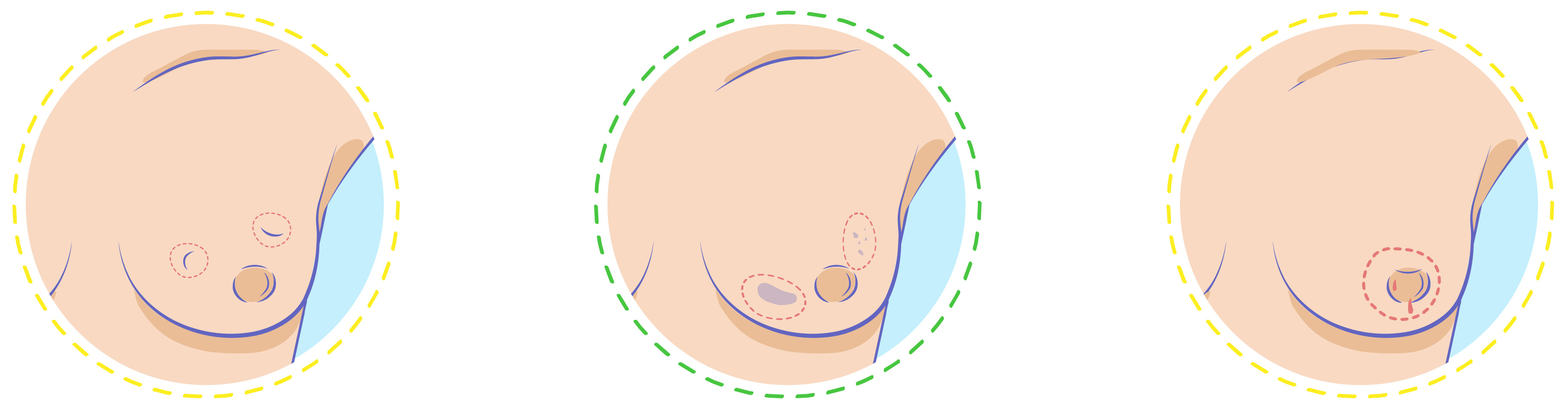 A series of three circular medical illustrations highlighting changes to look for during a breast exam, including lumps, dimpling, skin changes, and nipple discharge.