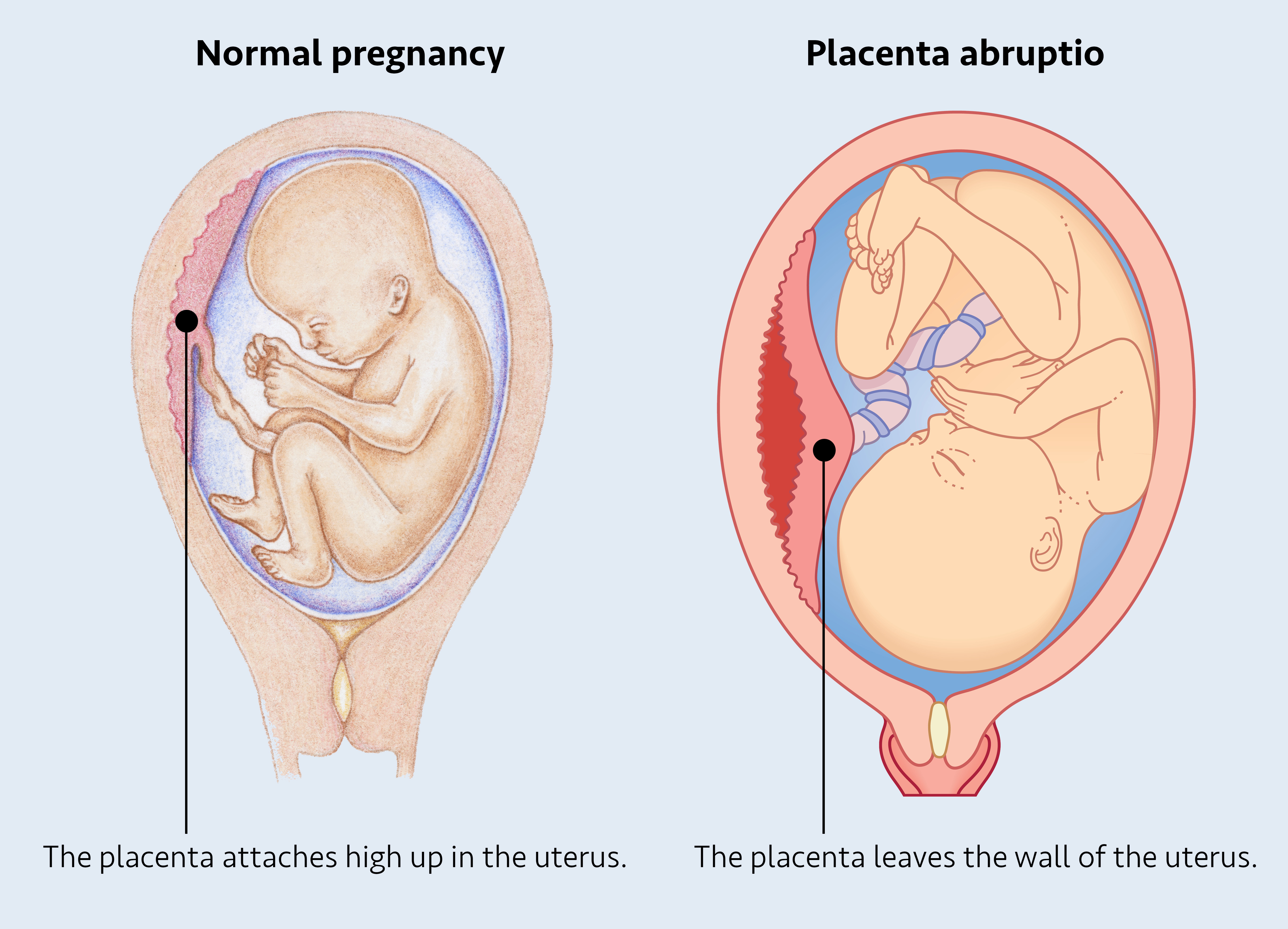 An anatomical comparison diagram side-by-side contrasting a normal pregnancy with placenta abruptio, where the placenta detaches from the uterine wall.