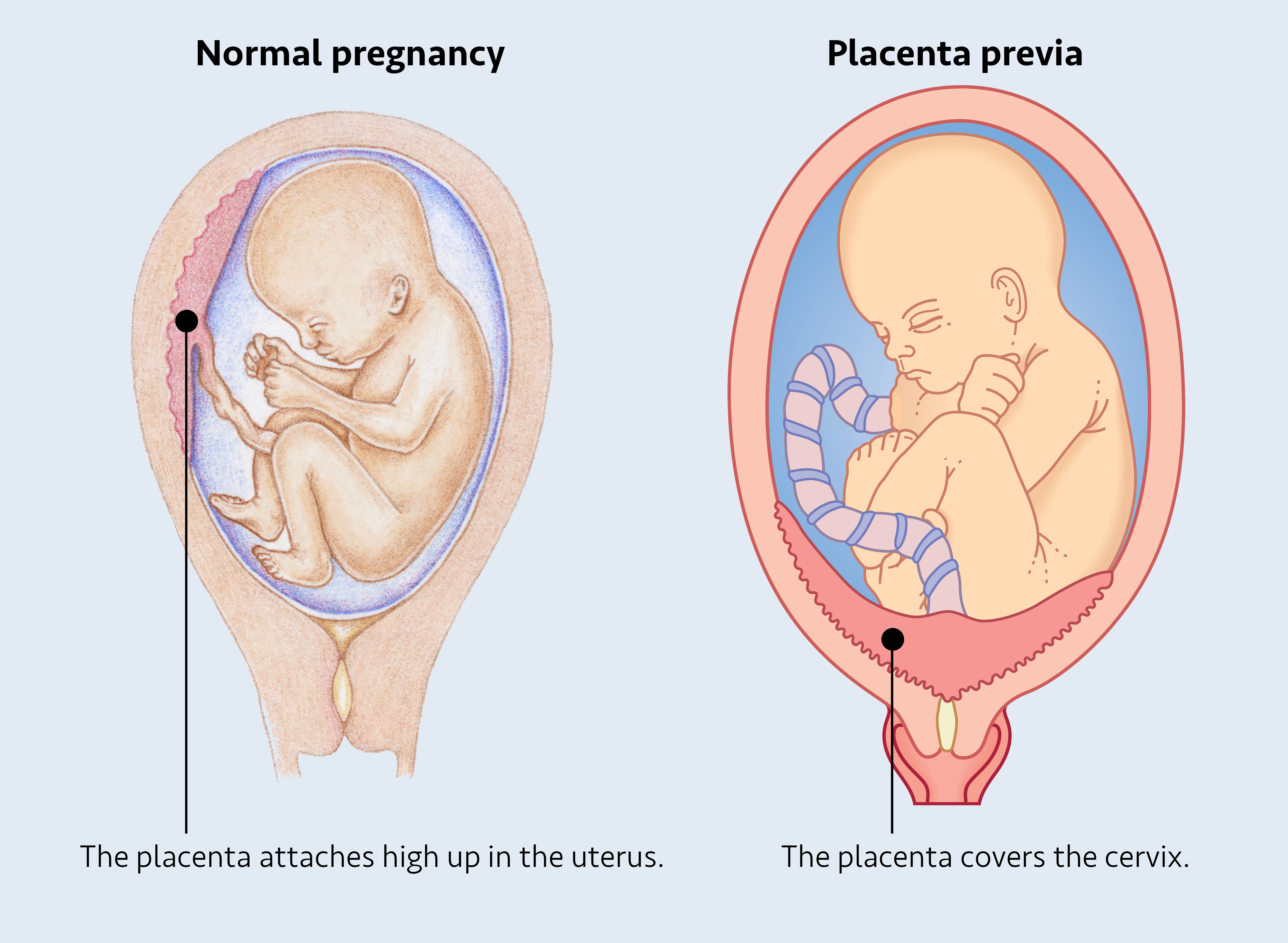 An anatomical comparison diagram side-by-side contrasting a normal pregnancy, where the placenta attaches high up, with placenta previa, where the placenta covers the cervix.