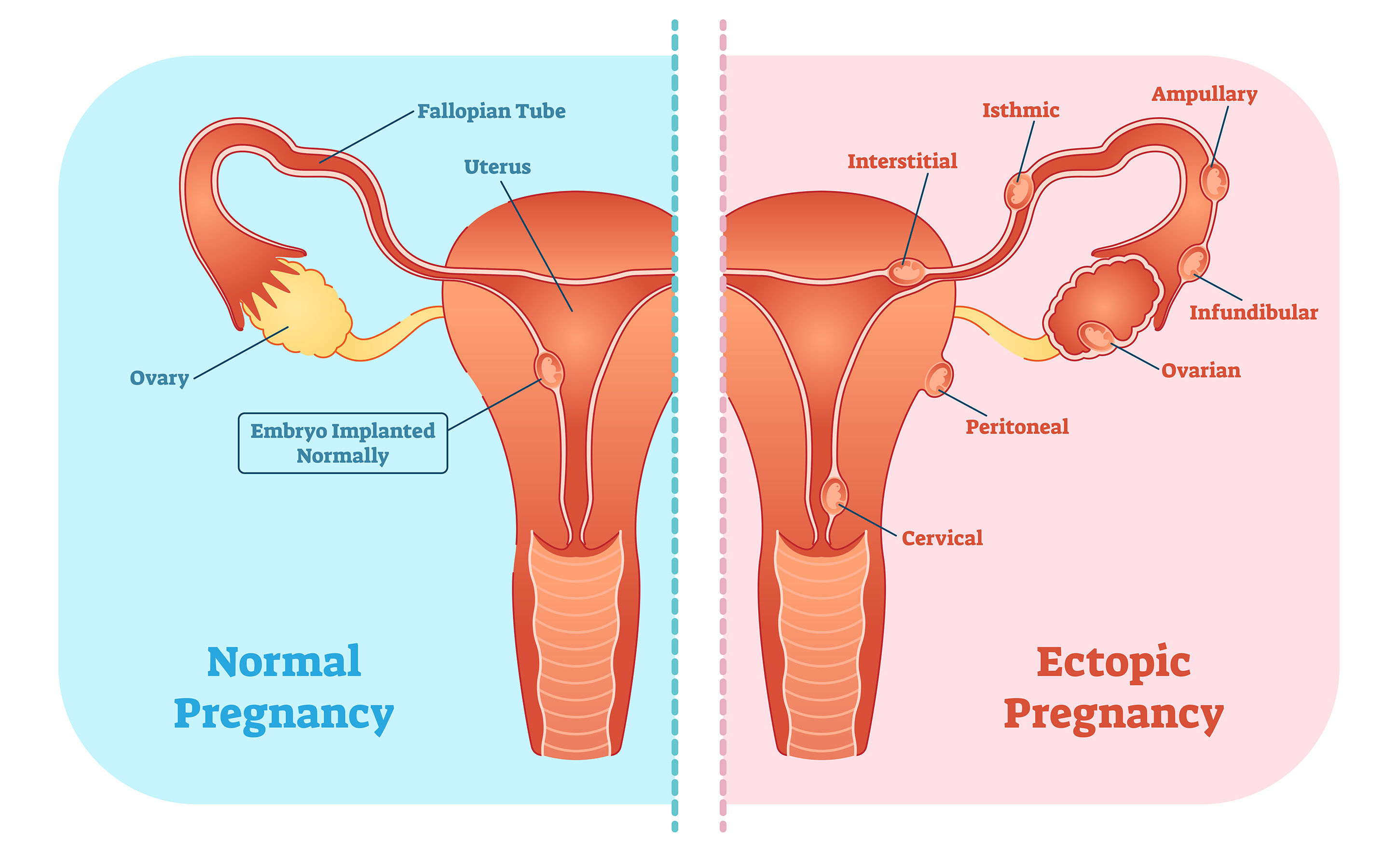 An anatomical diagram comparing a normal uterine pregnancy to an ectopic pregnancy, detailing abnormal embryo implantation sites like the fallopian tube, ovary, and cervix.