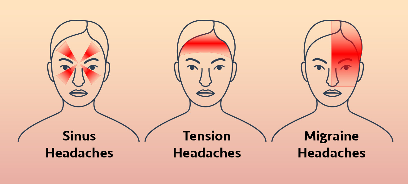 Medical infographic depicting the facial and head locations where pain is typically concentrated for sinus, tension, and migraine headaches.