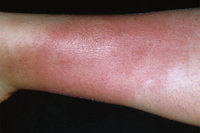 Cellulitis_Ill-1