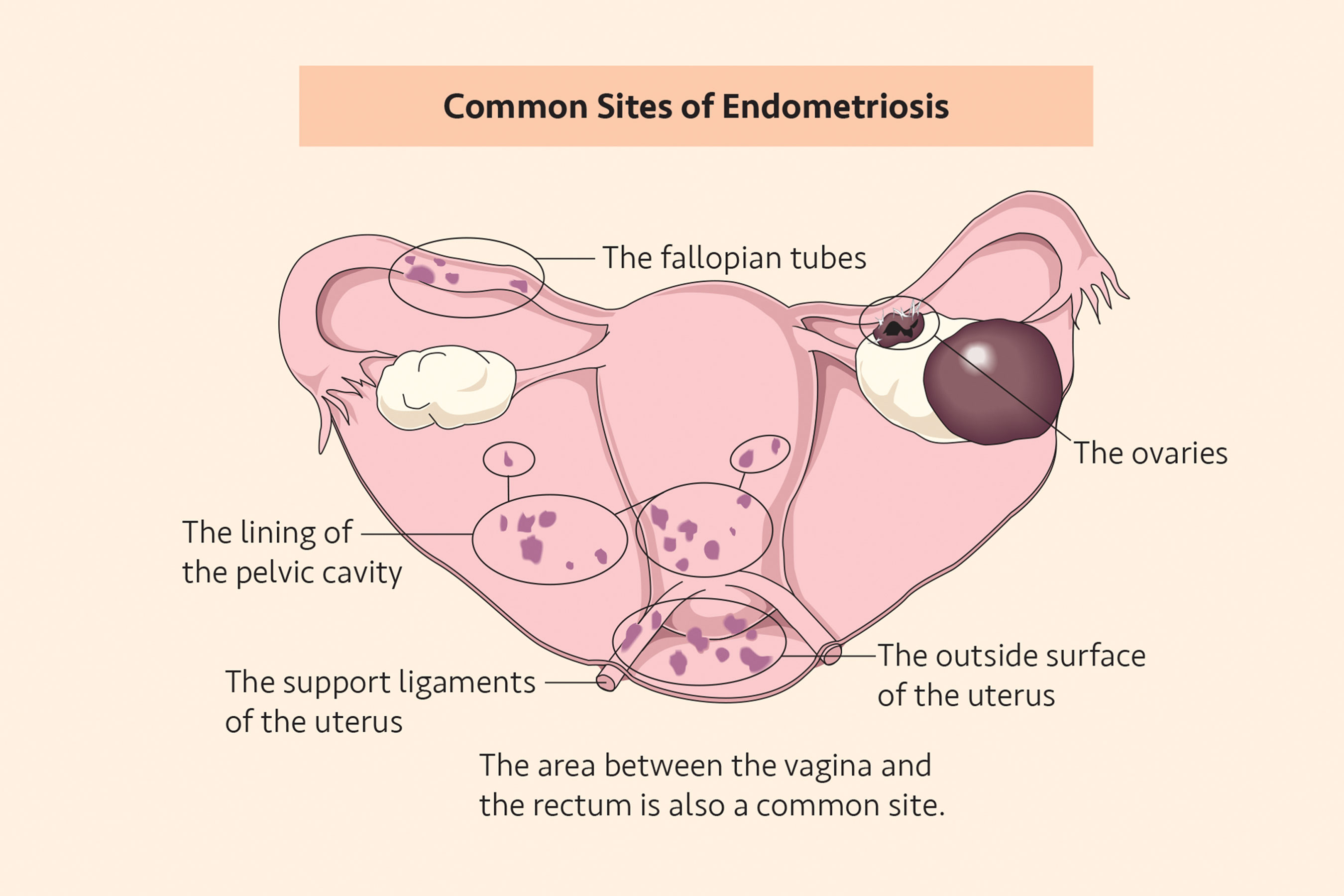 Labeled medical illustration of the female reproductive system showing common sites of endometriosis.