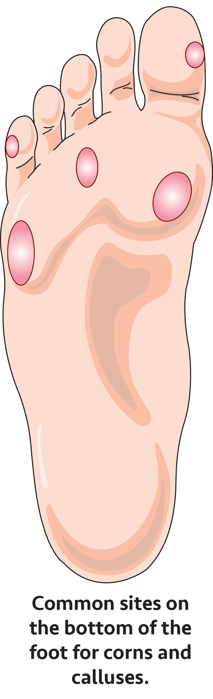 Corns-Calluses_Ill-1