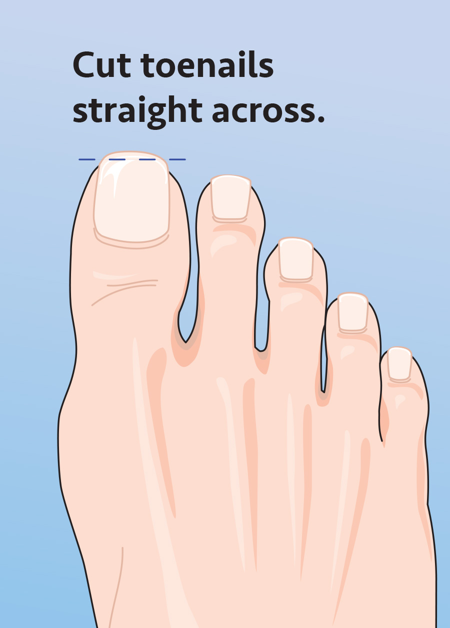 Cut-Toenails_Ill-2
