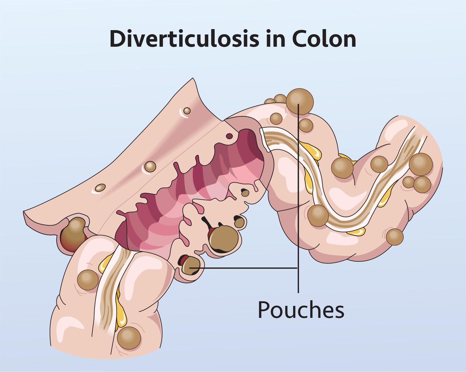 Diverticulosis_Ill-1