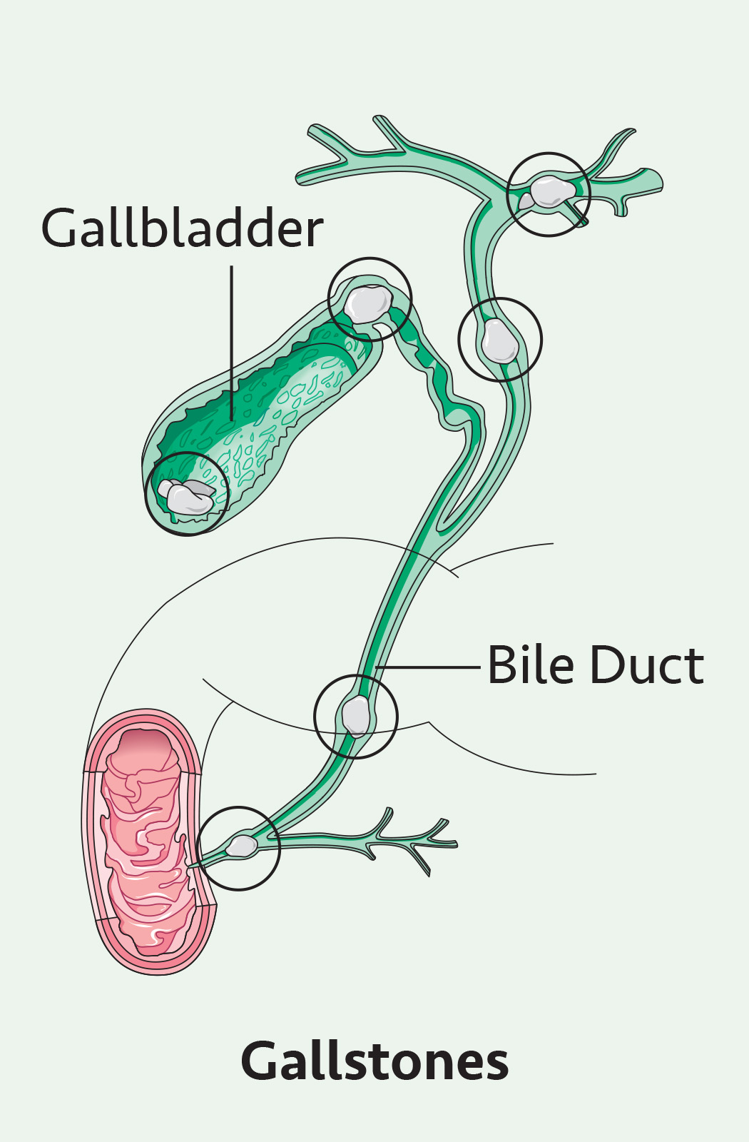Gallstones_Ill-1