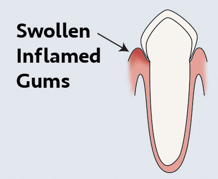Gingivitis_web