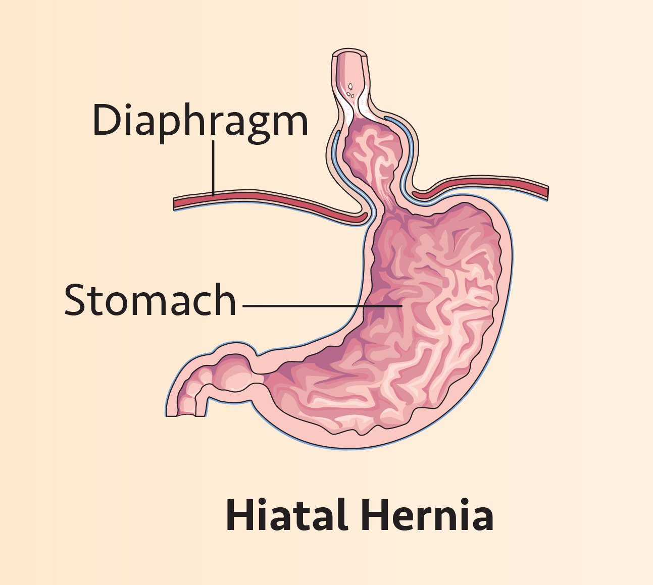 Hiatal-Hernia_Ill-1