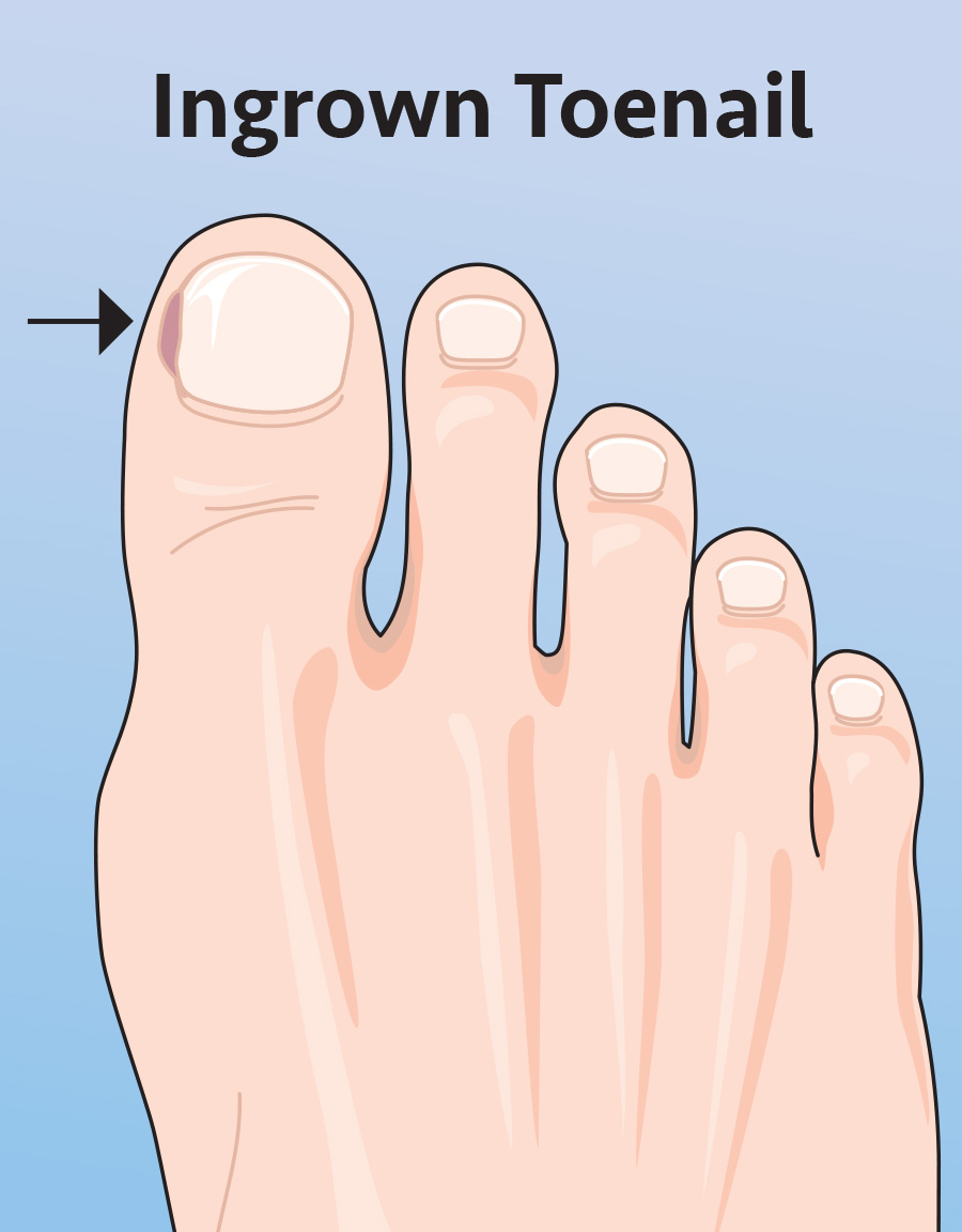 Ingrown-Toesnail_Ill-1