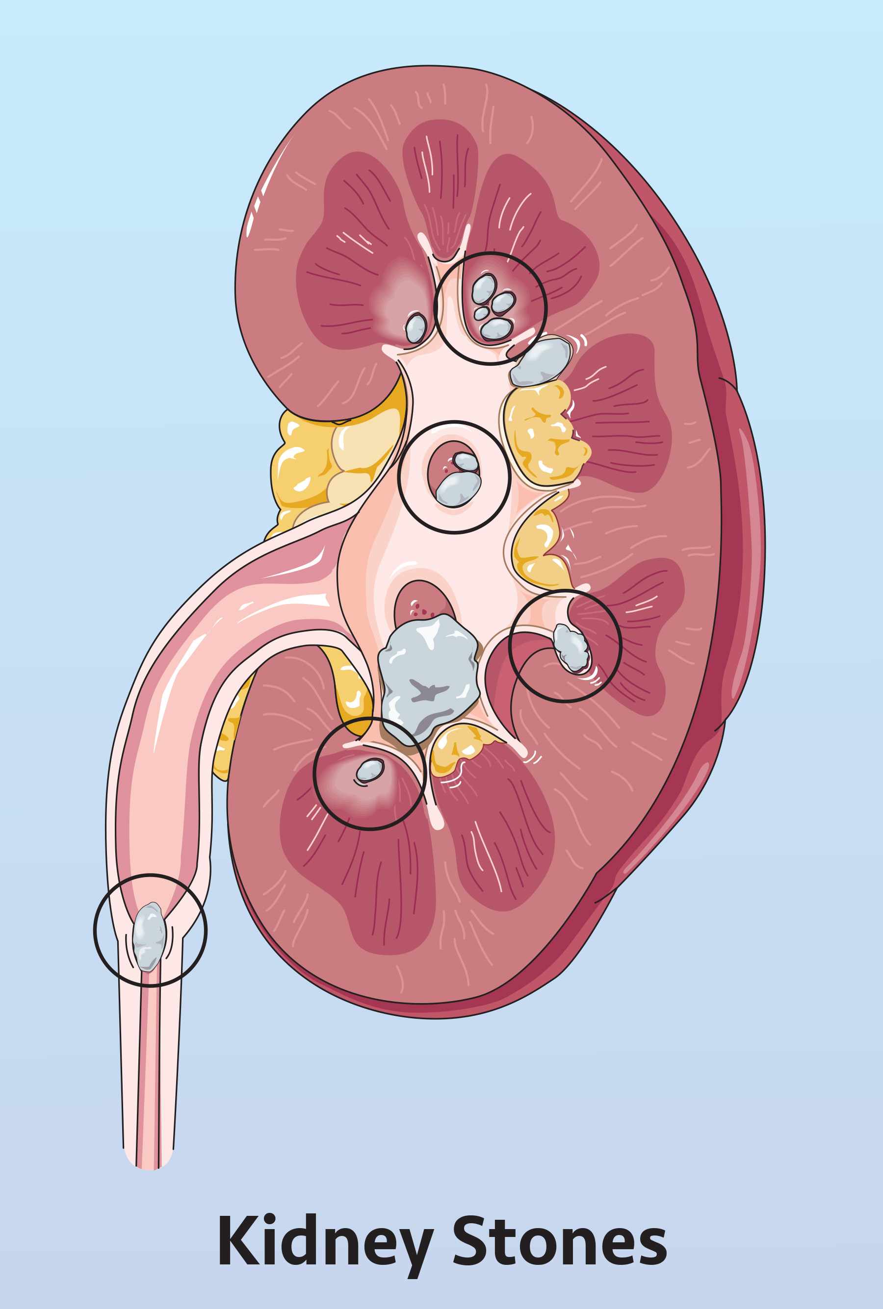 Kidney-Stones_Ill-1