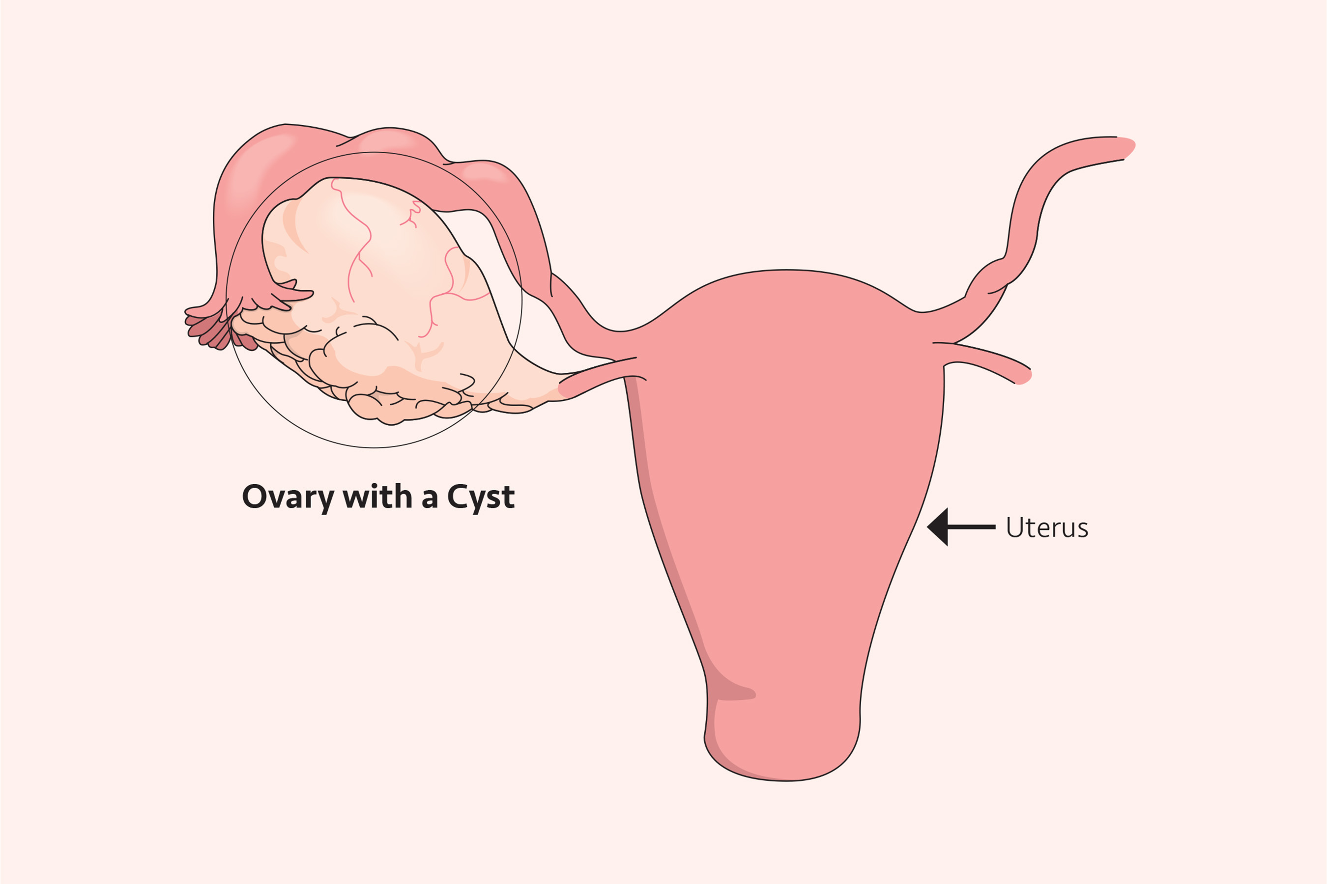 Anatomical illustration of the female reproductive system highlighting a large, round cyst growing on an ovary next to the uterus.