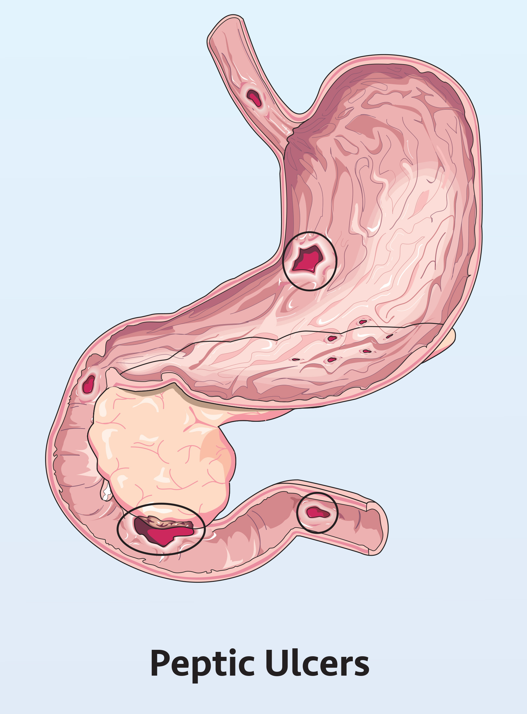 Peptic-Ulcers_Ill-1