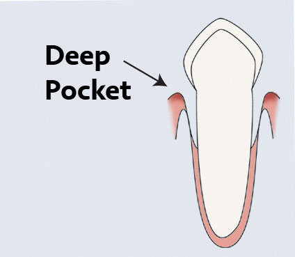 Peroidontitis_web