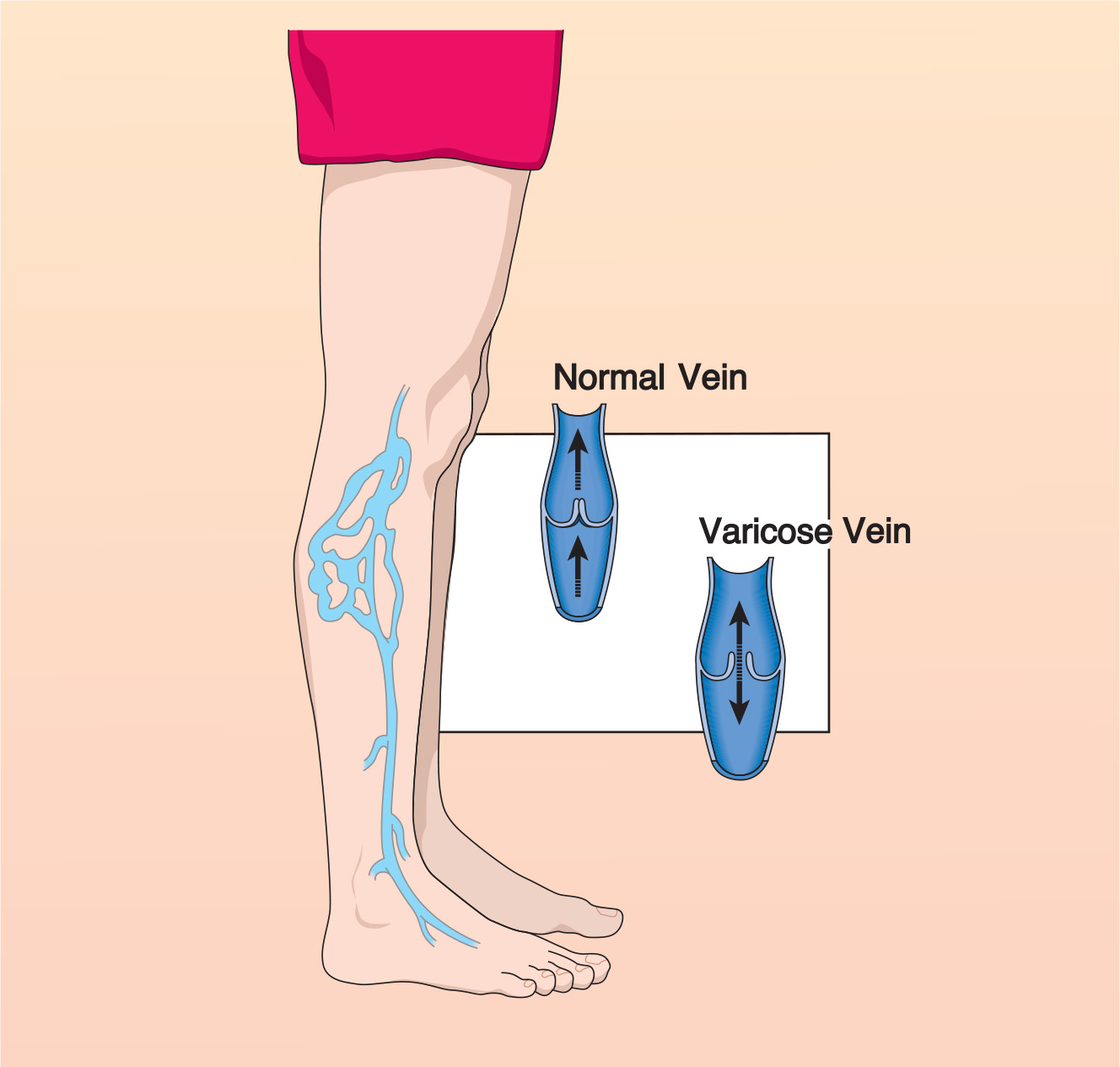 Anatomical diagram of a human leg illustrating the appearance of surface veins, with inset cross-section comparisons of a normal vein valve versus a malfunctioning varicose vein valve.