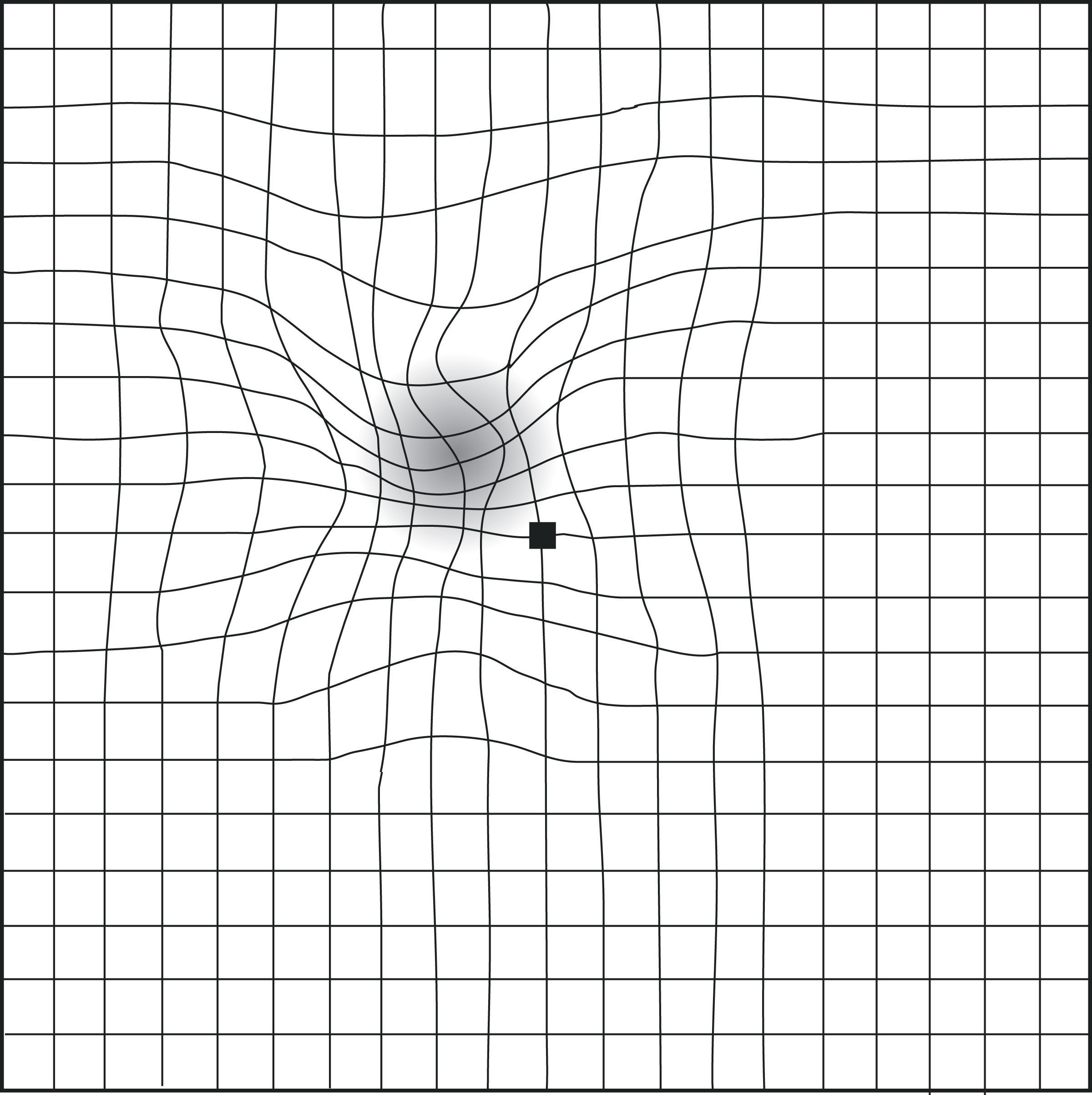 macular-degeneration-Ill-3