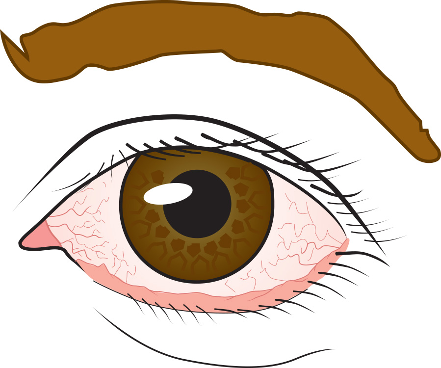 pink-eye_conjunctivitis_Ill-1