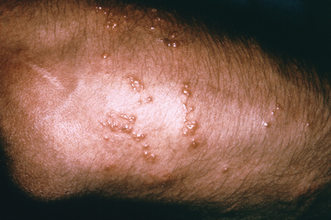 poison-ivy-rash_arm