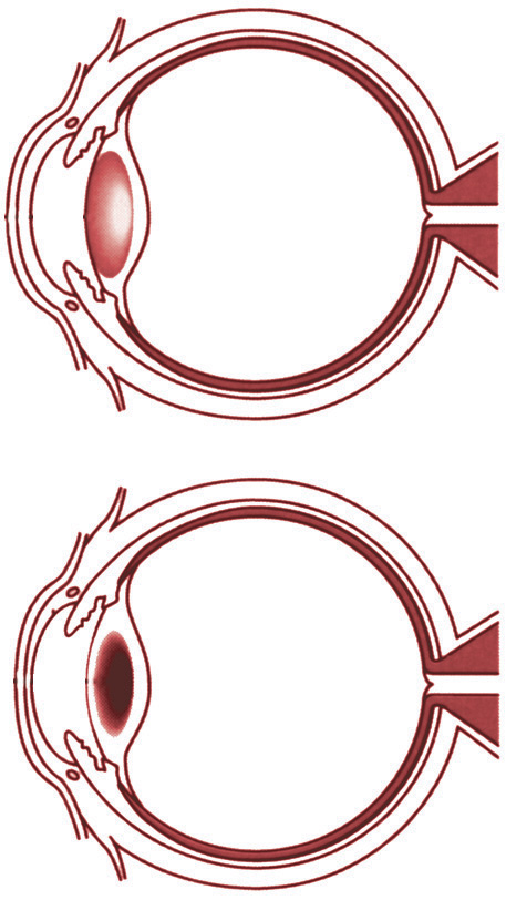 side-view-of-eye_Ill-1